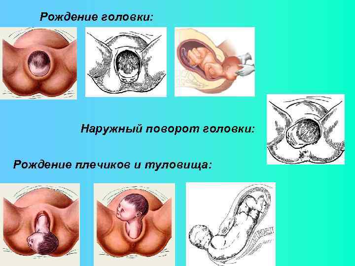 Рождение головки: Наружный поворот головки: Рождение плечиков и туловища: 