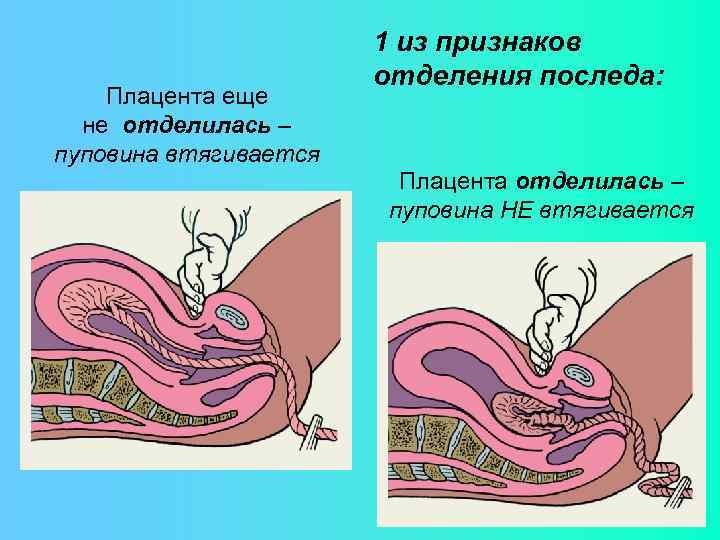 Плацента еще не отделилась – пуповина втягивается 1 из признаков отделения последа: Плацента отделилась