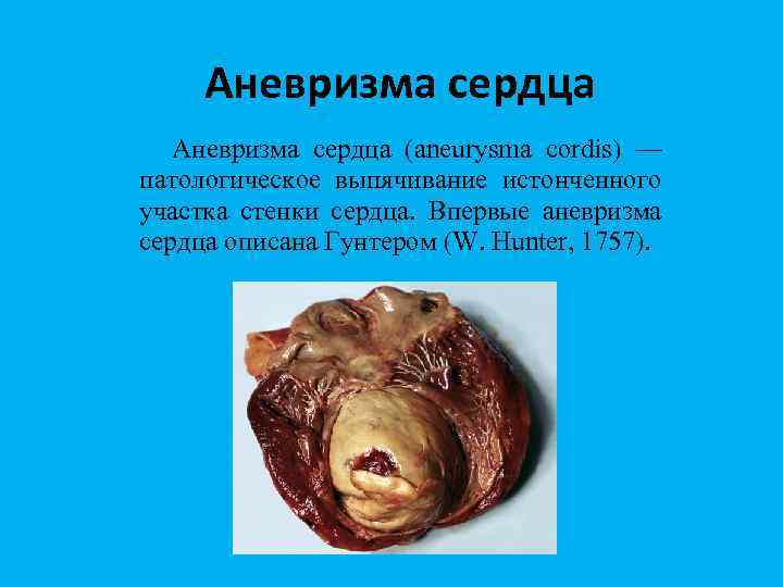 Аневризма сердца (aneurysma cordis) — патологическое выпячивание истонченного участка стенки сердца. Впервые аневризма сердца