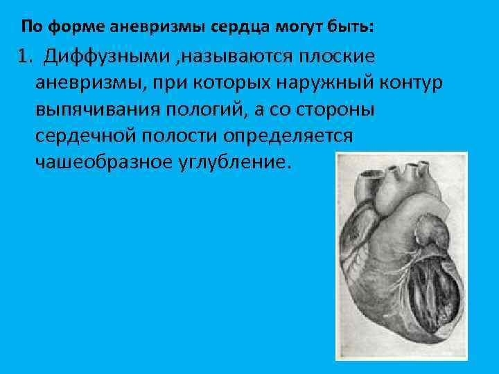 По форме аневризмы сердца могут быть: 1. Диффузными , называются плоские аневризмы, при которых