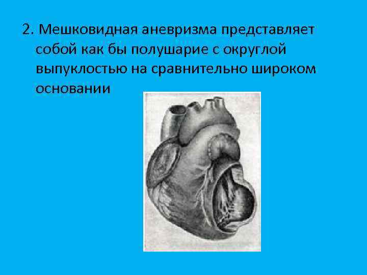 2. Мешковидная аневризма представляет собой как бы полушарие с округлой выпуклостью на сравнительно широком