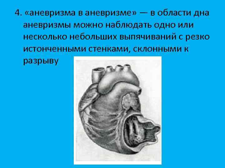4. «аневризма в аневризме» — в области дна аневризмы можно наблюдать одно или несколько