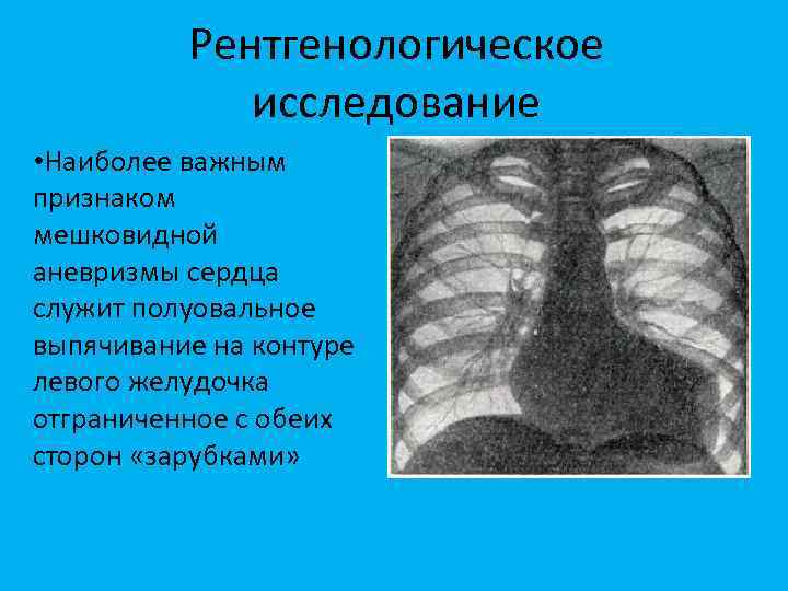 Аневризма сердца. Аневризма левого желудочка рентген. Аневризма левого желудочка сердца рентген. Мешковидное выпячивание сердца. Аневризма верхушки сердца.