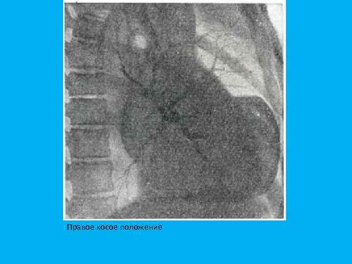 Правое косое положение 