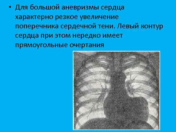 Аневризма желудочка рентген. Формы сердца на рентгенограмме. Границы расширены влево