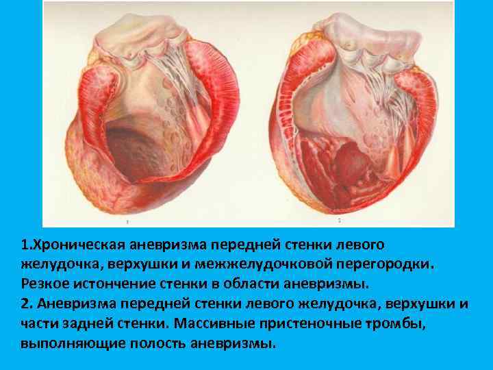 1. Хроническая аневризма передней стенки левого желудочка, верхушки и межжелудочковой перегородки. Резкое истончение стенки