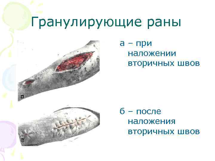 Гранулирующие раны а – при наложении вторичных швов б – после наложения вторичных швов