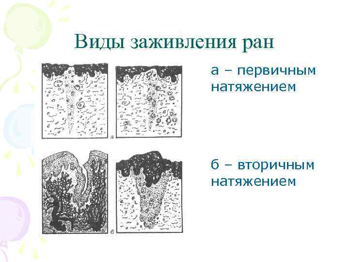 Виды заживления ран а – первичным натяжением б – вторичным натяжением 
