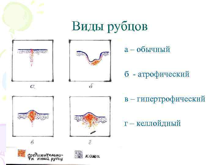 Виды рубцов а – обычный б - атрофический в – гипертрофический г – келлойдный