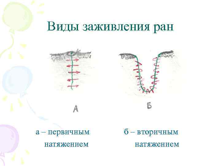 Виды заживления ран а – первичным натяжением б – вторичным натяжением 