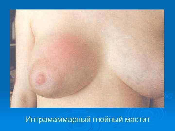 Интрамаммарный гнойный мастит 