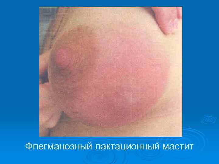 Флегманозный лактационный мастит 