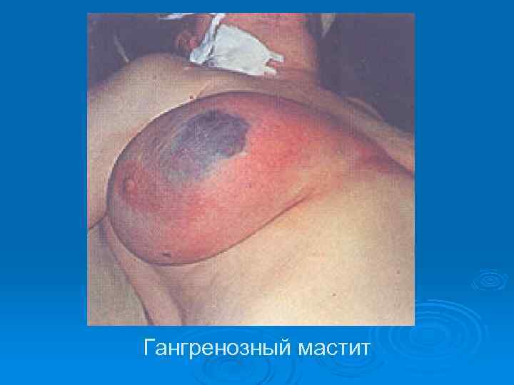 Гангренозный мастит 