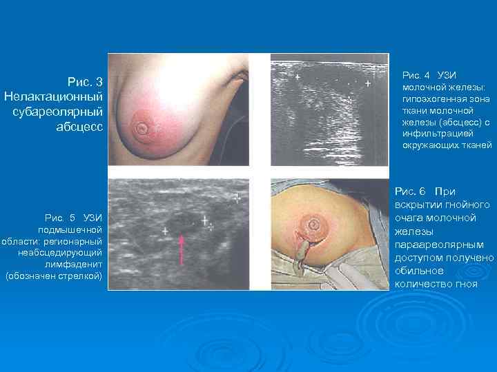 Рис. 3 Нелактационный субареолярный абсцесс Рис. 5 УЗИ подмышечной области: регионарный неабсцедирующий лимфаденит (обозначен