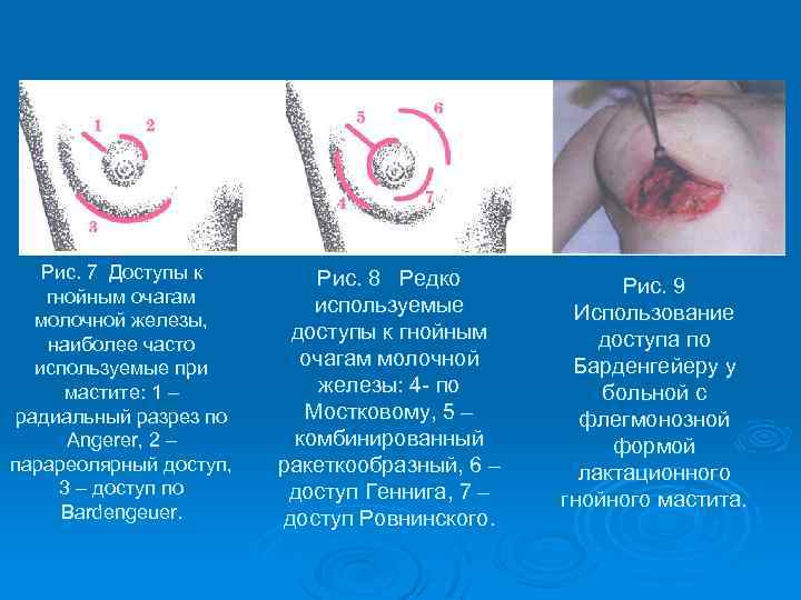 Рис. 7 Доступы к гнойным очагам молочной железы, наиболее часто используемые при мастите: 1