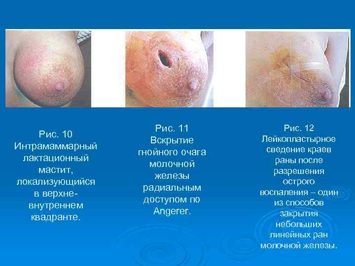 Рис. 10 Интрамаммарный лактационный мастит, локализующийся в верхневнутреннем квадранте. Рис. 11 Вскрытие гнойного очага