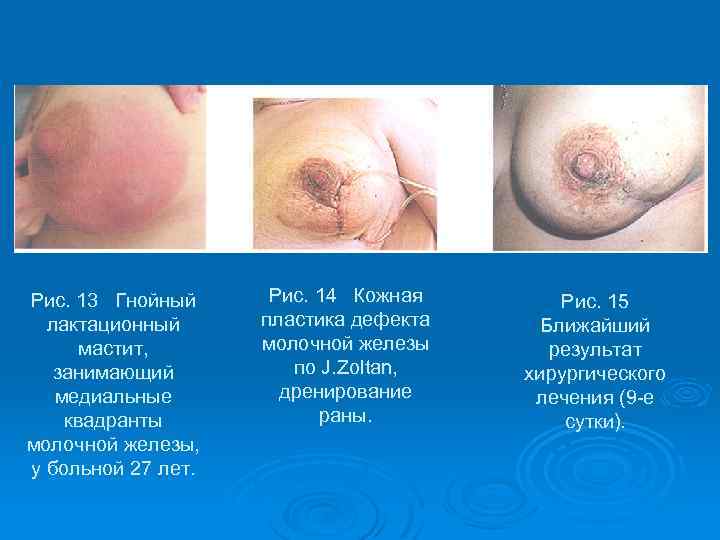 Рис. 13 Гнойный лактационный мастит, занимающий медиальные квадранты молочной железы, у больной 27 лет.