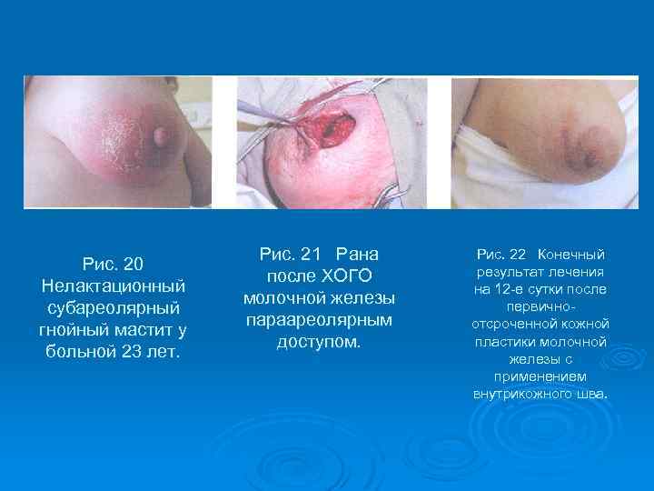 Рис. 20 Нелактационный субареолярный гнойный мастит у больной 23 лет. Рис. 21 Рана после