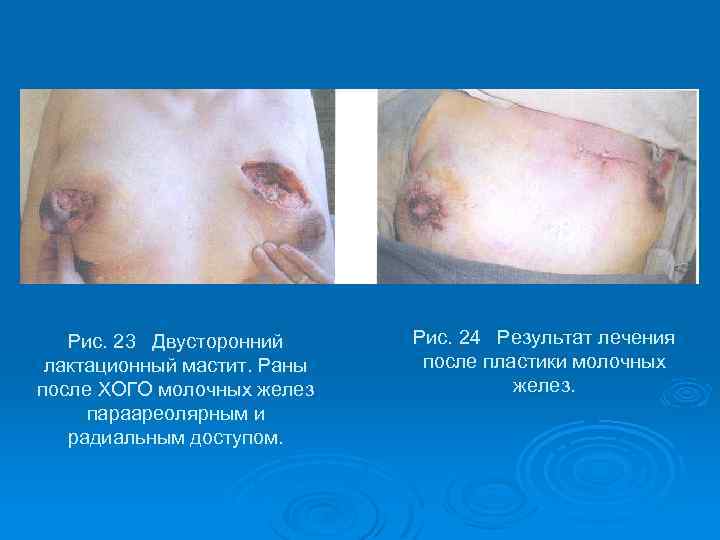Рис. 23 Двусторонний лактационный мастит. Раны после ХОГО молочных желез параареолярным и радиальным доступом.