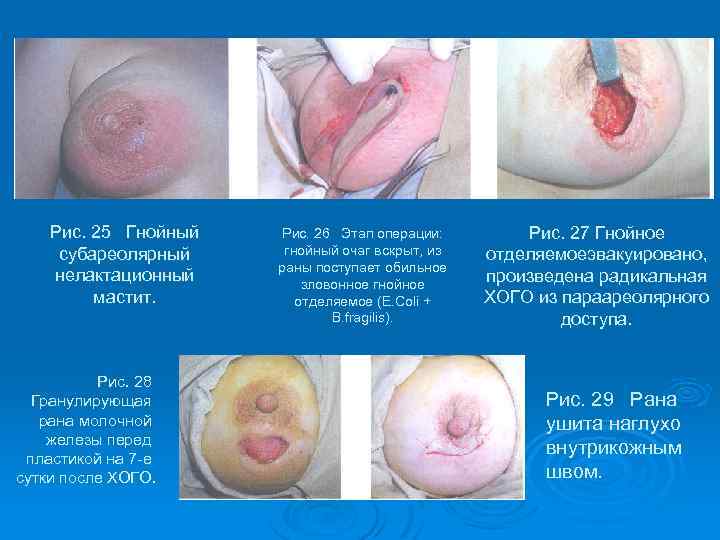 Рис. 25 Гнойный субареолярный нелактационный мастит. Рис. 28 Гранулирующая рана молочной железы перед пластикой