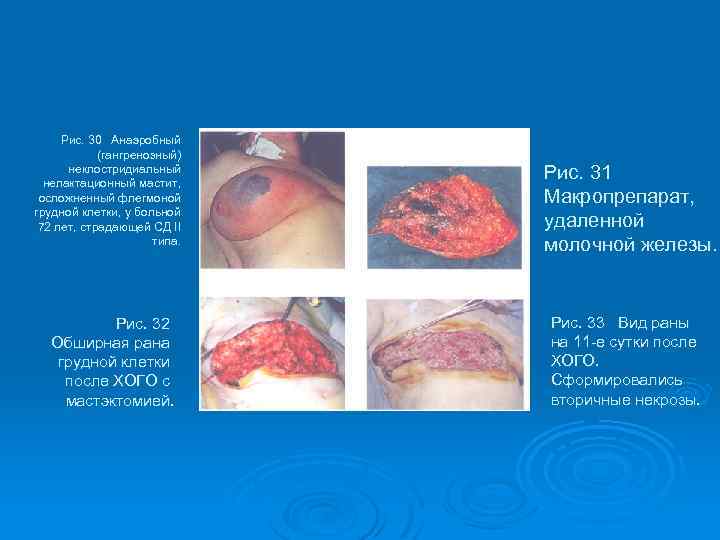Рис. 30 Анаэробный (гангренозный) неклостридиальный нелактационный мастит, осложненный флегмоной грудной клетки, у больной 72