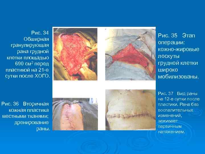 Рис. 34 Обширная гранулирующая рана грудной клетки площадью 690 см 2 перед пластикой на