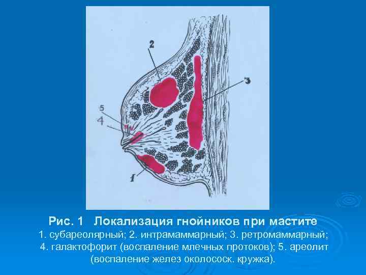 Рис. 1 Локализация гнойников при мастите 1. субареолярный; 2. интрамаммарный; 3. ретромаммарный; 4. галактофорит
