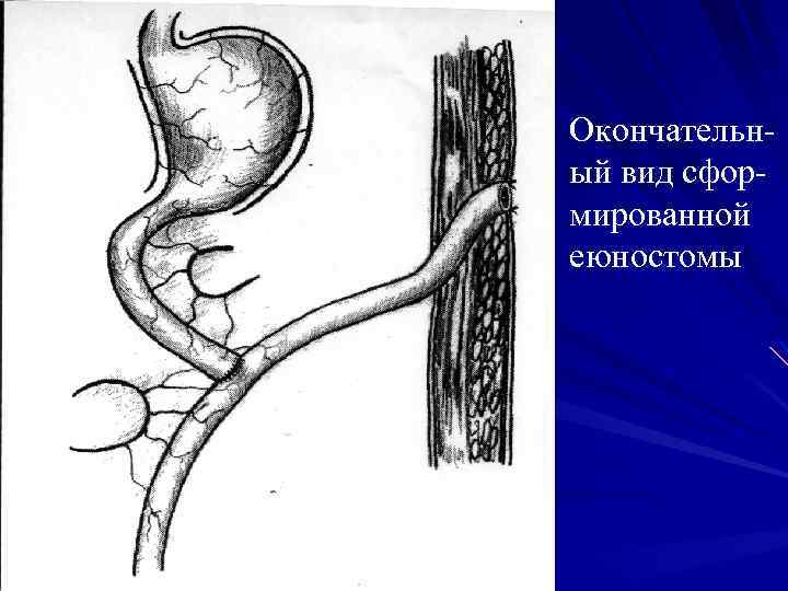 Еюностома. Питательная еюностома.