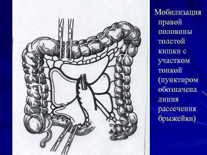 Мобилизация правой половины толстой кишки с участком тонкой (пунктиром обозначена линия рассечения брыжейки) 