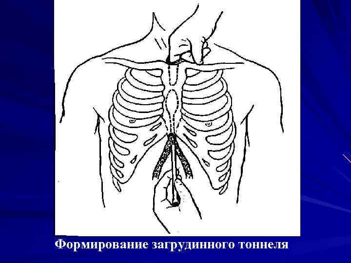 Рисунок Формирование загрудинного тоннеля 