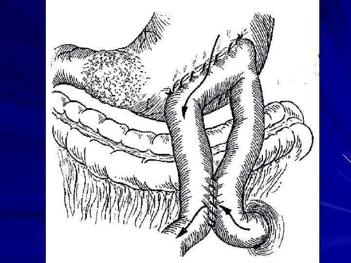 Анастомоз по брауну схема