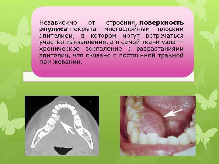Независимо от строения, поверхность эпулиса покрыта многослойным плоским эпителием, в котором могут встречаться участки