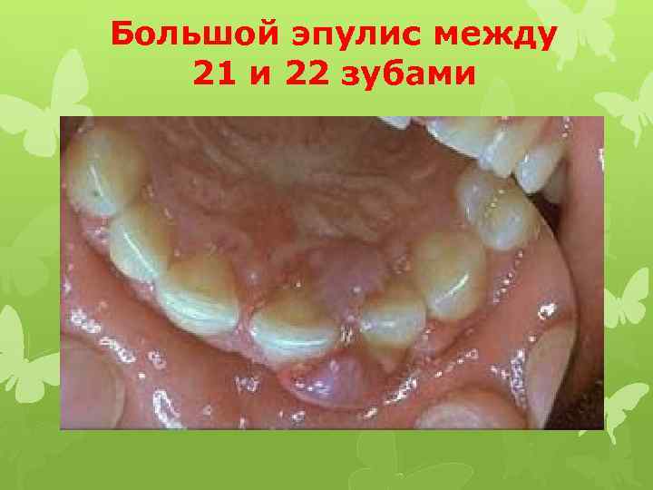 Большой эпулис между 21 и 22 зубами 