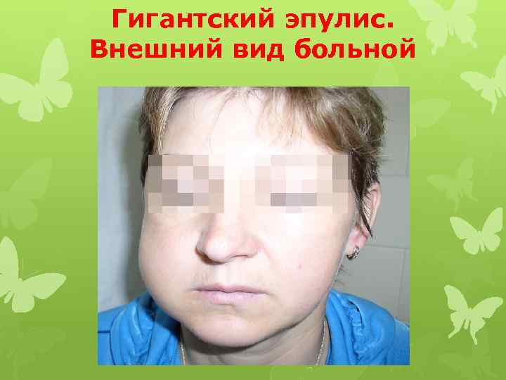 Гигантский эпулис. Внешний вид больной 
