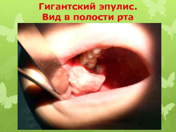 Гигантский эпулис. Вид в полости рта 
