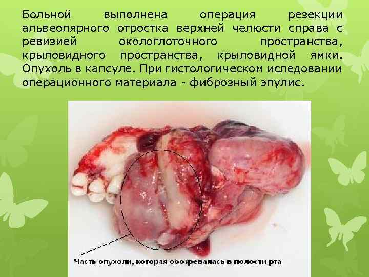 Больной выполнена операция резекции альвеолярного отростка верхней челюсти справа с ревизией окологлоточного пространства, крыловидной