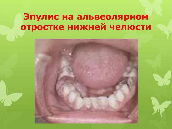 Эпулис на альвеолярном отростке нижней челюсти 