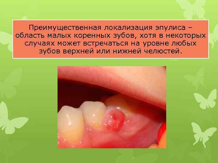 Преимущественная локализация эпулиса – область малых коренных зубов, хотя в некоторых случаях может встречаться