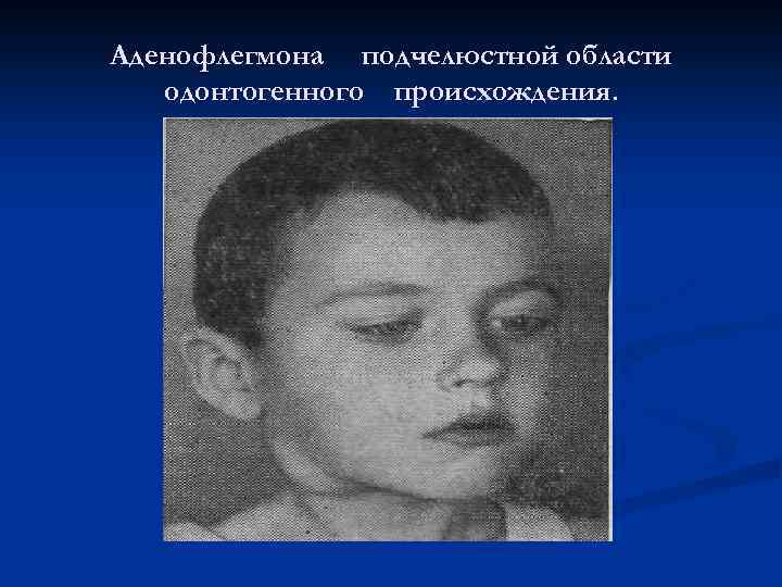 Аденофлегмона подчелюстной области одонтогенного происхождения 