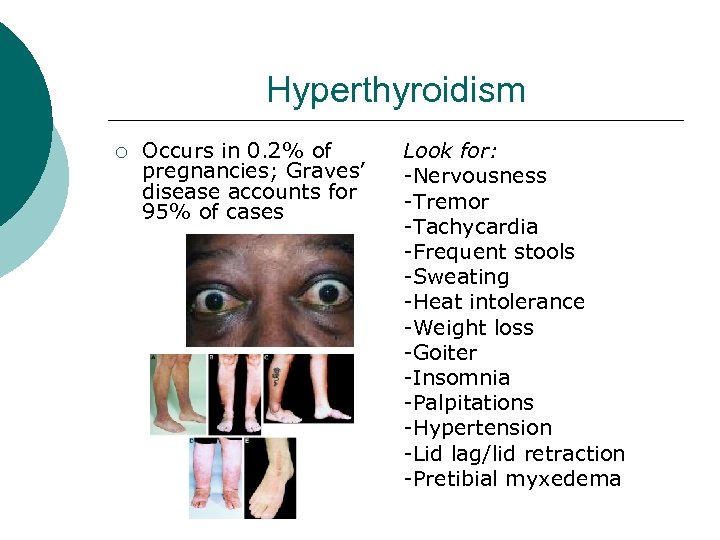 Hyperthyroidism ¡ Occurs in 0. 2% of pregnancies; Graves’ disease accounts for 95% of