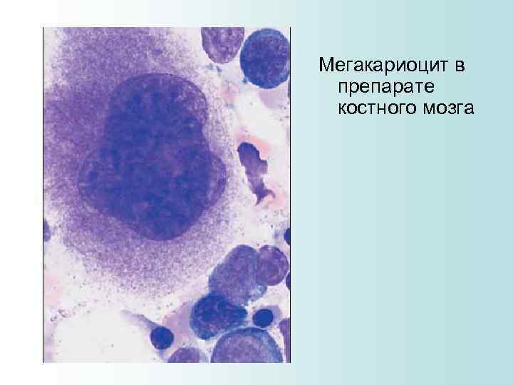 Мегакариоцит в препарате костного мозга 