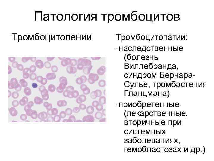 Тромбоцитарная пурпура у детей фото