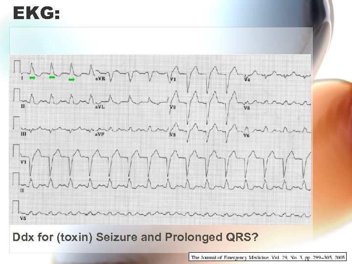 EKG: Ddx for (toxin) Seizure and Prolonged QRS? 