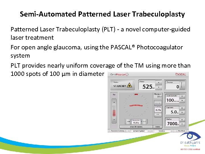 Semi-Automated Patterned Laser Trabeculoplasty (PLT) - a novel computer-guided laser treatment For open angle