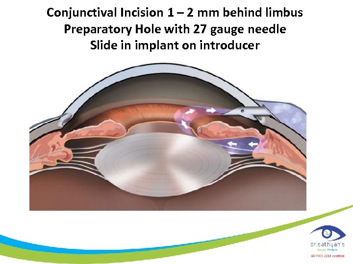 Conjunctival Incision 1 – 2 mm behind limbus Preparatory Hole with 27 gauge needle