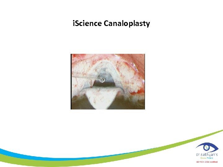 i. Science Canaloplasty 