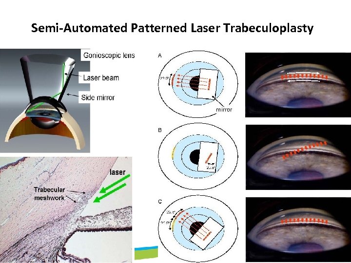 Semi-Automated Patterned Laser Trabeculoplasty 
