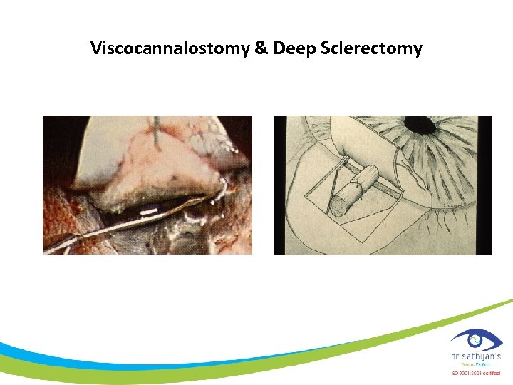 Viscocannalostomy & Deep Sclerectomy 