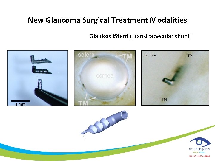 New Glaucoma Surgical Treatment Modalities Glaukos i. Stent (transtrabecular shunt) 