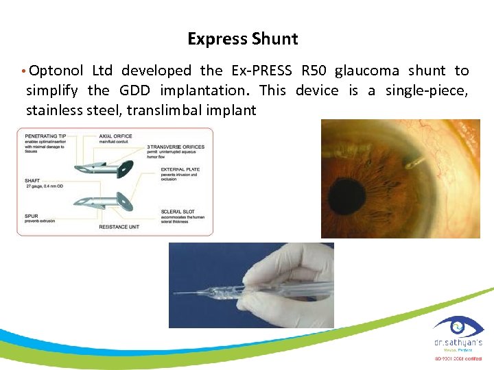 Express Shunt • Optonol Ltd developed the Ex-PRESS R 50 glaucoma shunt to simplify
